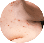 Child with chickenpox rash