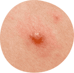 A chickenpox scab
